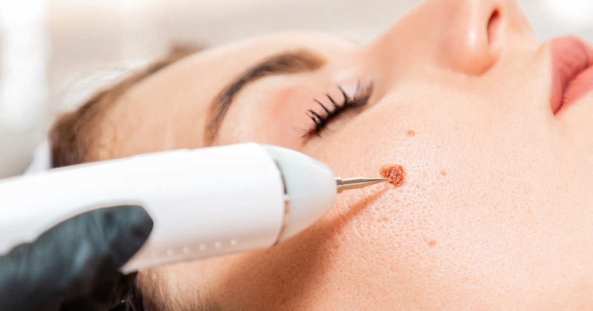 Mole Removal Canberra | Cosmetic Mole Removal | R Clinic